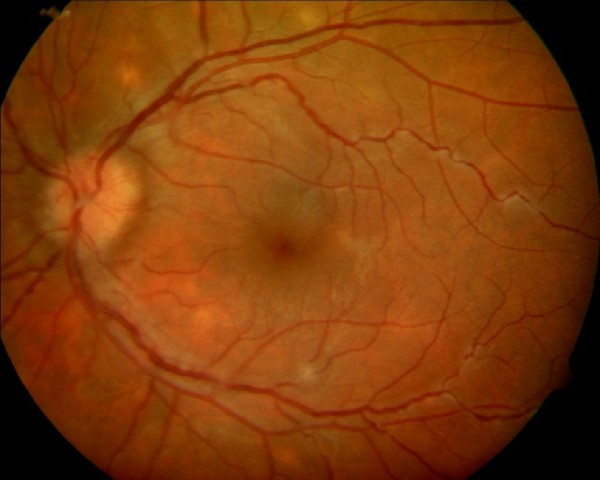 Chirurgia Colorettale Colectomia con Verde Indocianina