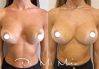 momogirl-dottoressa-moio-chirurgia-estetica