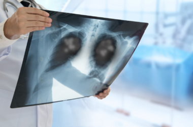 polmonite bilaterale