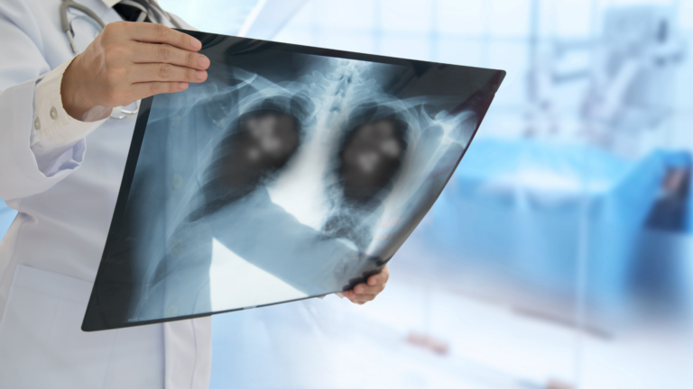 polmonite bilaterale